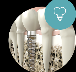 implantat