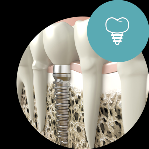 implantat